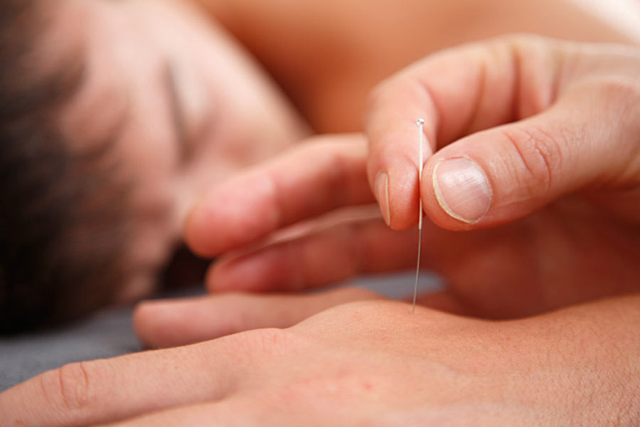 Acupuncture