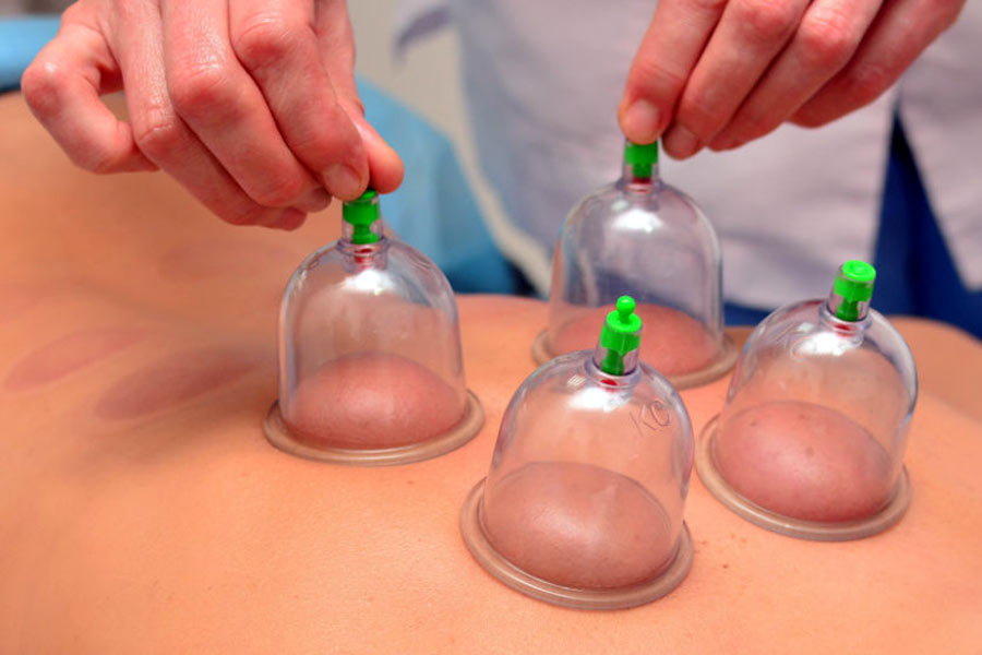 Cupping