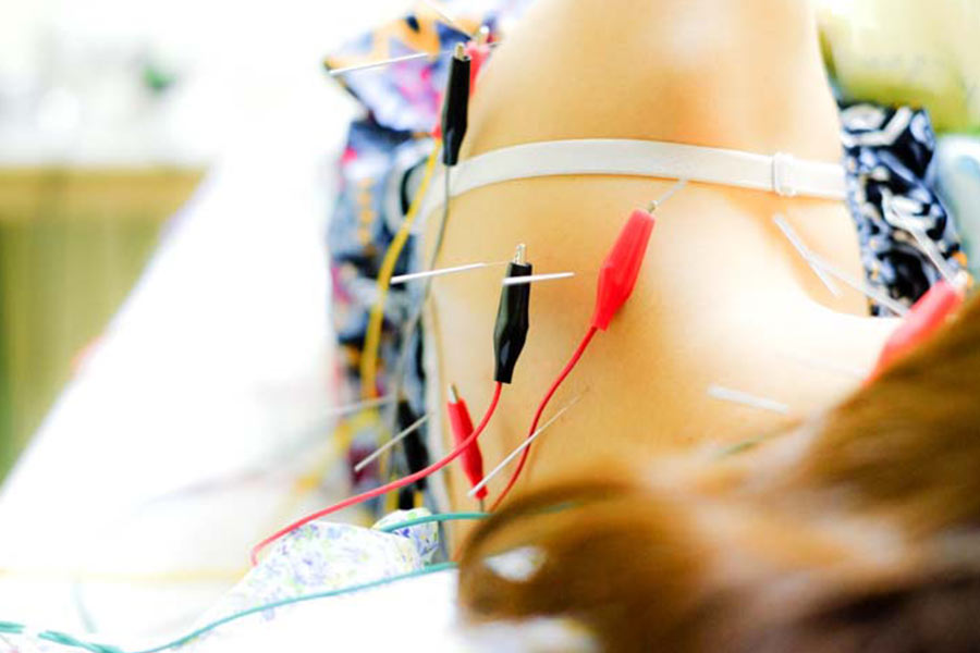 Electro Acupuncture