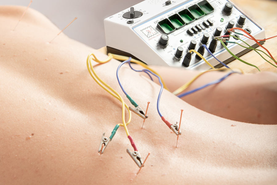 Electro Acupuncture